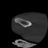 SPORK, NICO - 22.03.1976 - 02.08.2022 - CT obere Extremität - 17:51:17
